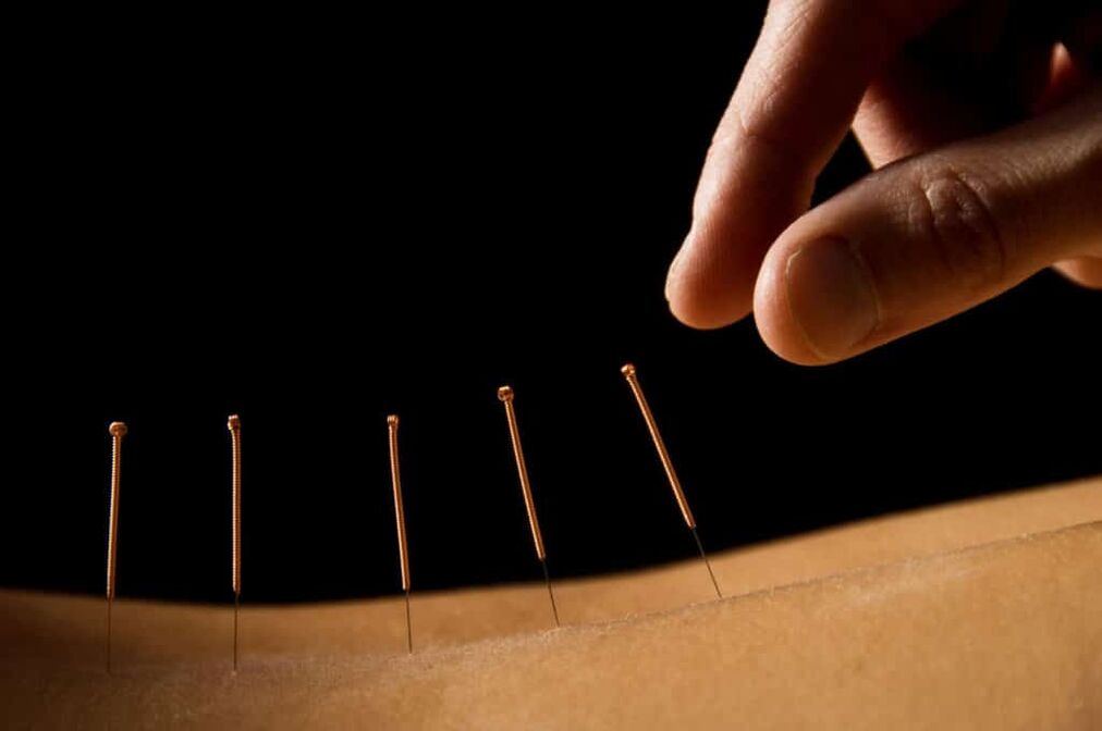Acupuncture for prostate inflammation