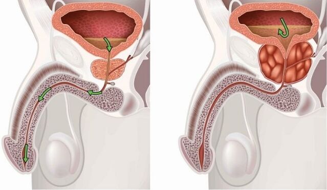 Healthy and aching prostate