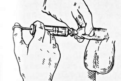 Instillations for prostatitis
