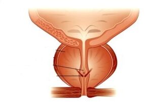 Prostatitis and its treatment with medications