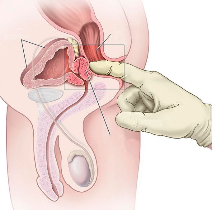 Prostate massage to treat prostatitis